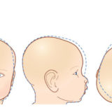 Neonati: aumento l&#8217;incidenza della plagiocefalia posizionale posteriore, Plagiocefalia Posizionale